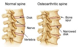 Arthritis Cervical Spine Treatment Doctor | Back Pain Specialist NYC