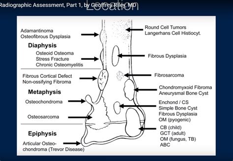 Radiographic Assessment of Bone Lesions — OrthopaedicPrinciples.com