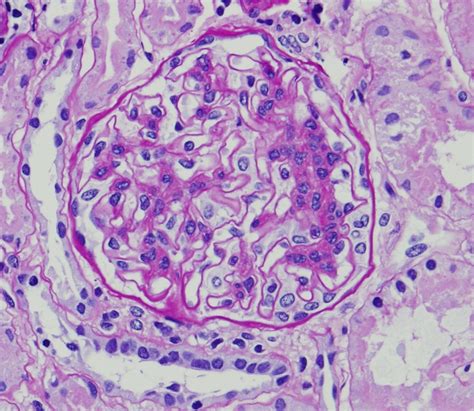 Renal Pathology Review: Non-IgA mesangioproliferative glomerulonephritis