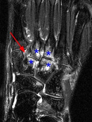 Lisfranc Ligament Tear - Radsource