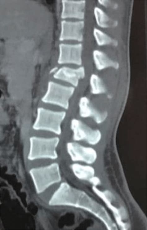 Patient one: Pre-operative CT scan of the thoracolumbar junction... | Download Scientific Diagram