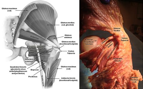 Surgically Relevant Bony and Soft Tissue Anatomy of the Proximal Femur ...