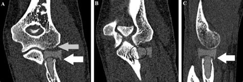 -CT Scan of the left elbow in coronal section in A and B, and in... | Download Scientific Diagram