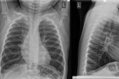 Chest X Ray Bronchitis Vs Pneumonia