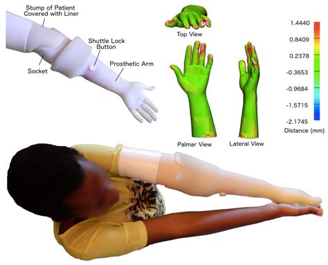 A Method for 3-D Printing Patient-Specific Prosthetic Arms With High ...