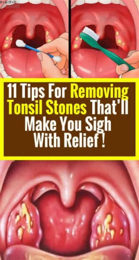 Tonsillitis Tonsil Stones