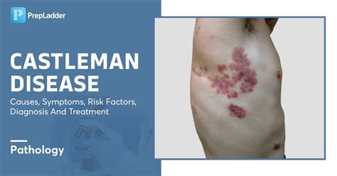 Castleman Disease Causes, Symptoms, Risk Factors, Diagnosis and Treatment