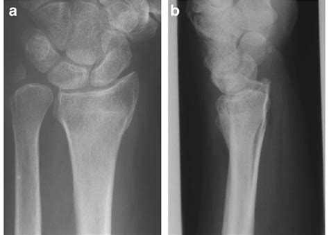 X-ray of a wrist with a distal radius fracture that has healed in... | Download Scientific Diagram