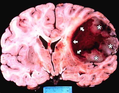 Glioblastoma: nuovo promettente trattamento - MediMagazine