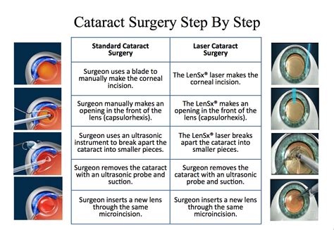 cataract surgery process - Gailey Eye Clinic