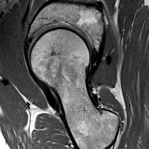 Hip MRI