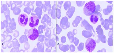 Blood smear at high magnification (100X) at the time of diagnosis:... | Download Scientific Diagram