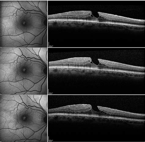 Role of Lamellar Hole–Associated Epiretinal Proliferation in Lamellar Macular Holes - American ...