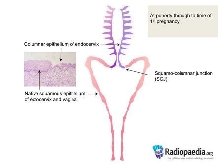 Squamo-columnar junction - cervix | Image | Radiopaedia.org | Cervix, Image, Junction