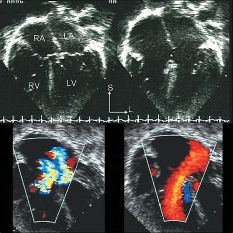 Atrioventricular Av Canal Defects