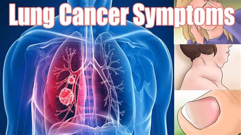 Lung Cancer Signs And Symptoms