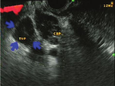 Endoscopic ultrasound image of a cholangiocarcinoma with complete ...