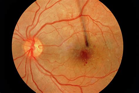 Ophthalmoscopy Of Maculopathy In Diabetic's Eye Photograph by Sue Ford ...