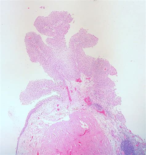 Papillary Urothelial Neoplasm of Low Malignant Potential (PUNLMP), Urinary Bladder | Flickr ...