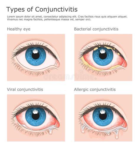 Types of Conjunctivitis Illustration Stock Vector - Illustration of ...