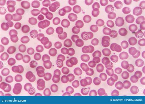 Blood smear stock photo. Image of therapy, test, medicine - 80361074