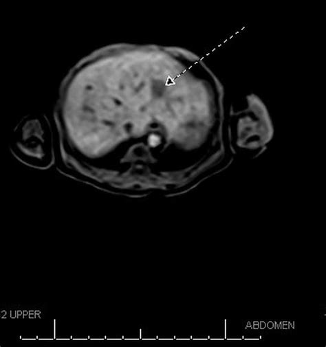 Post-surgery MRI showing intra-hepatic lesion (arrow). | Download Scientific Diagram