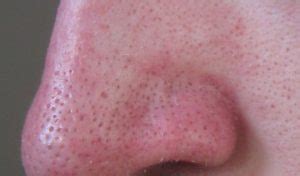 Large Pores on Nose Causes and Ways to Shrink Them - Skincarederm