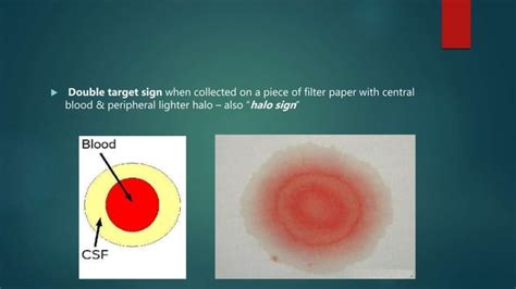 Csf Rhinorrhea - Overview