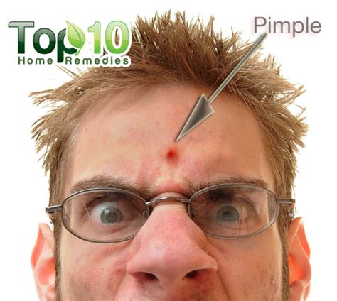 How to Get Rid of Pimples Fast | Top 10 Home Remedies