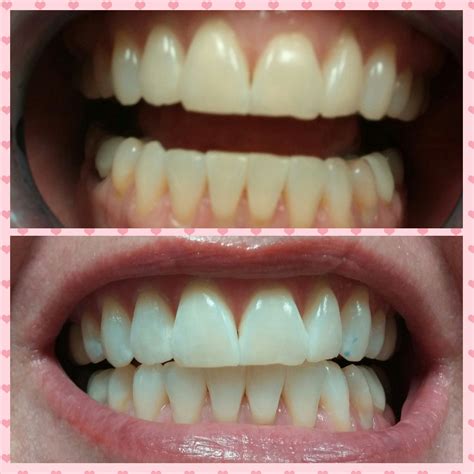 LED / Laser Teeth Whitening - Before & After | Teeth Whitening ...