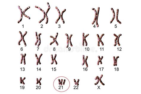 Cariotipo Di Sindrome Di Down Illustrazione di Stock - Illustrazione di macro, femmina: 81631766