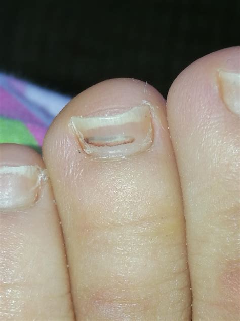 There's this black line across my toenail. What does it mean? : r/medical