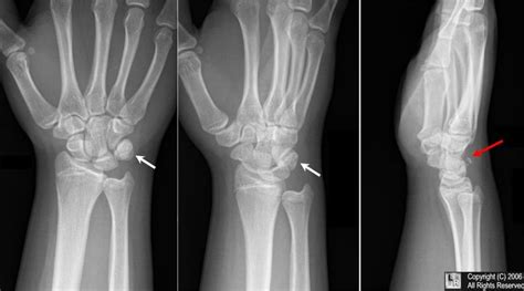 LearningRadiology.com - Triquetral Fracture, Triquetrum, Fracture