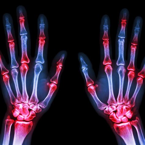 Researchers Explore Effect of Prednisone For Rheumatoid Arthritis Biologics Treatments