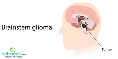 Glioma: Causes, Symptoms And Treatment