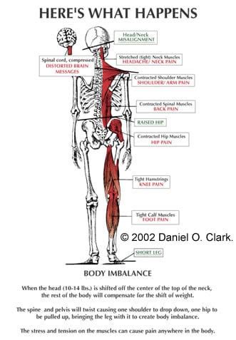 Misaligned vertebrae in neck | doctorvisit