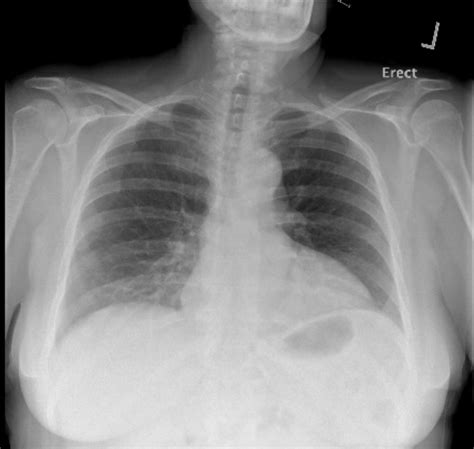 X Ray Images Of Aortic Tear