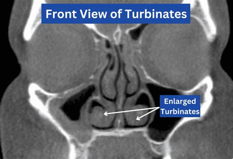 Inferior Turbinate Reduction - AESC