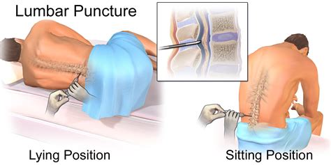 My Family Medicine Practice: Lumbar Puncture