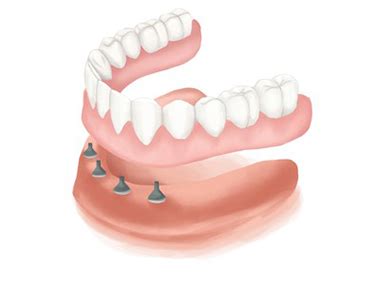 Full Denture Implants Cost - Dental News Network