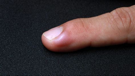 How To Treat Ingrown Fingernails At Home? Effective Methods