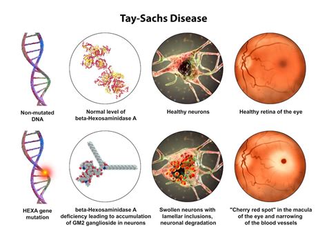 Tay-Sachs disease - Mind Map