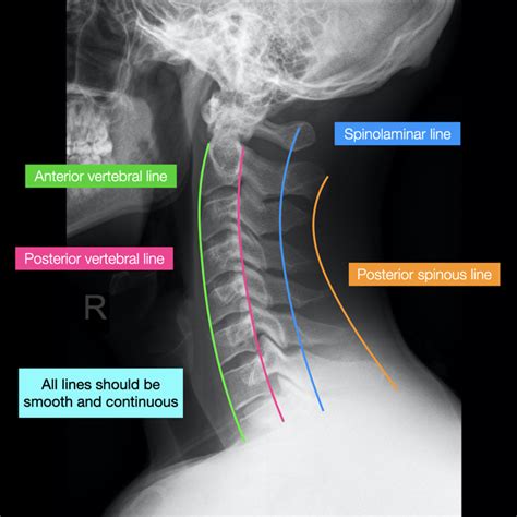 Normal Cervical Spine