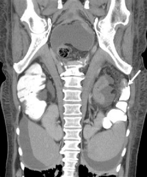 Obstructive colonic stricture seen within the descending colon (arrow). | Download Scientific ...