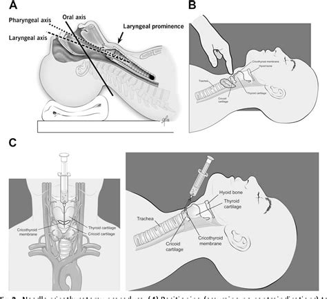 Needle cricothyrotomy. | Semantic Scholar