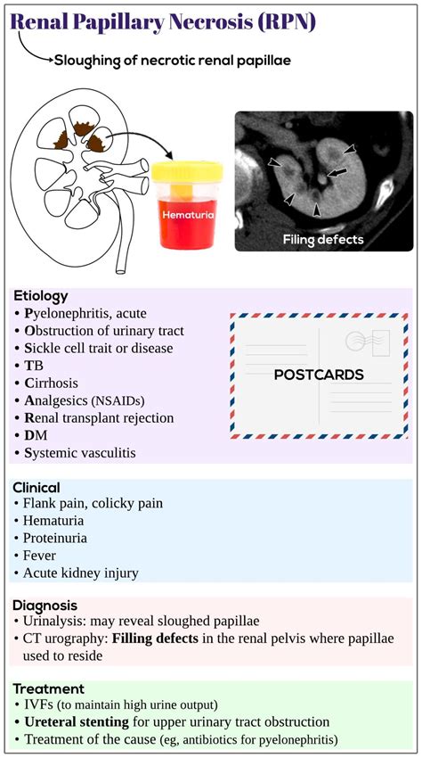 Renal papillary necrosis (RPN) - Medicine Keys for MRCPs