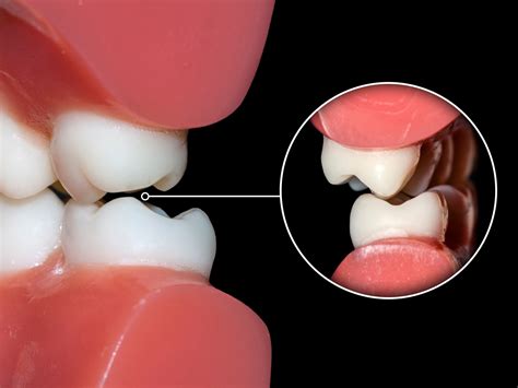 What is Dental Occlusion?