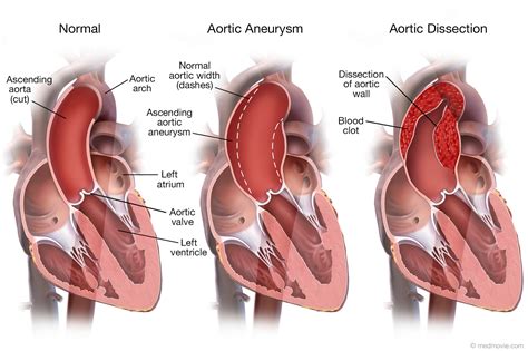Medmovie.com | Aortic Aneurysm and Aortic Dissection