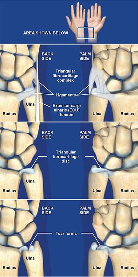 Triangular Fibrocartilage Complex (TFCC) Tears | Central Coast Orthopedic Medical Group