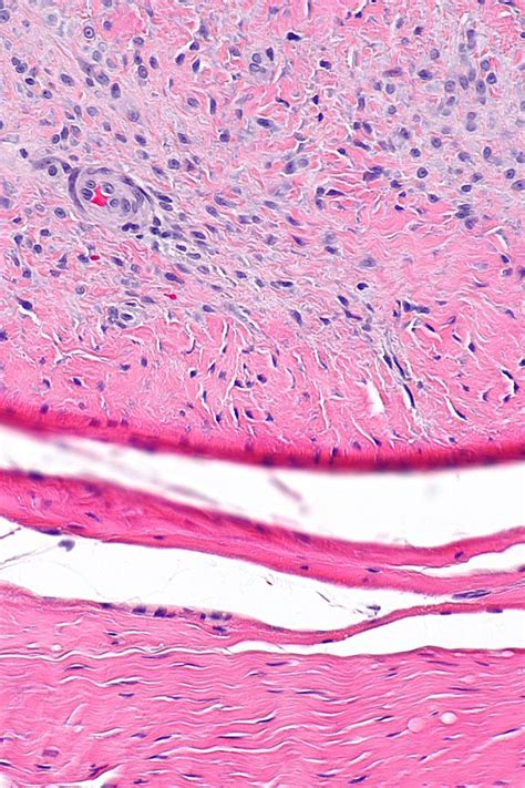 Palmar fibromatosis - Libre Pathology